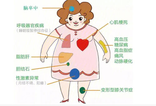 對(duì)肥胖大聲說(shuō)NO!——我院開(kāi)展腹腔鏡（微創(chuàng)）下胃部分切除術(shù)