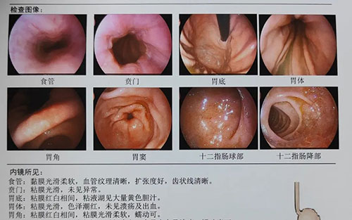 對(duì)肥胖大聲說(shuō)NO!——我院開(kāi)展腹腔鏡（微創(chuàng)）下胃部分切除術(shù)