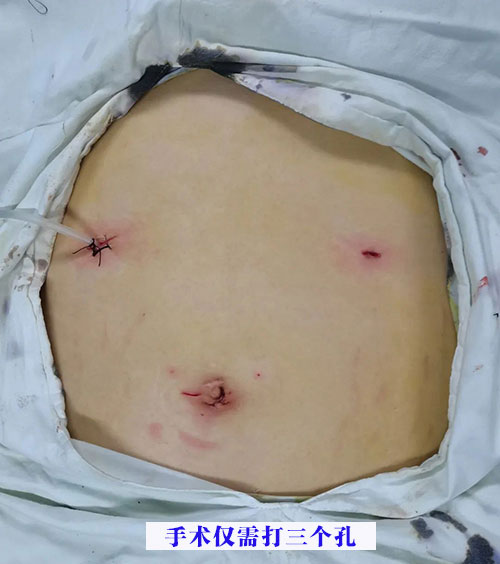 對(duì)肥胖大聲說(shuō)NO!——我院開(kāi)展腹腔鏡（微創(chuàng)）下胃部分切除術(shù)