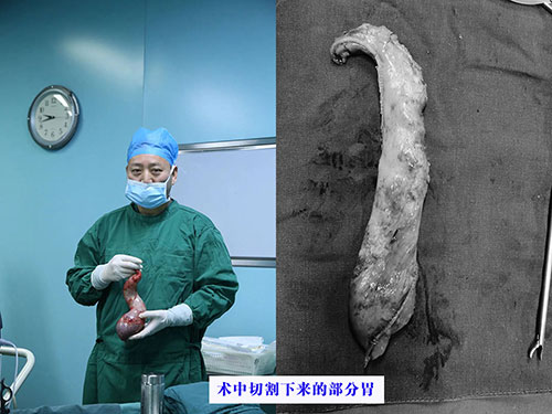 對(duì)肥胖大聲說(shuō)NO!——我院開(kāi)展腹腔鏡（微創(chuàng)）下胃部分切除術(shù)