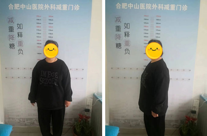 減重代謝手術(shù)，減的不只是“體重”