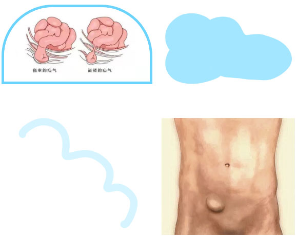 勿以“疝”小而不為:正確認(rèn)識(shí)腹股溝疝