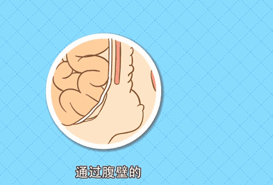 勿以“疝”小而不為:正確認(rèn)識(shí)腹股溝疝