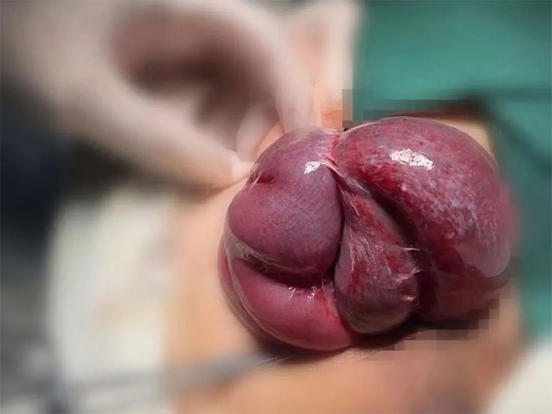 勿以“疝”小而不為:正確認(rèn)識(shí)腹股溝疝