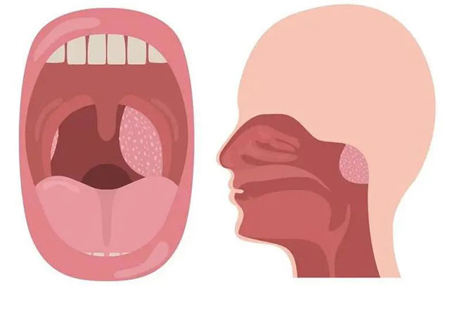 娃睡覺(jué)張嘴，打呼嚕？警惕腺樣體肥大