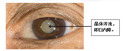 關(guān)于白內(nèi)障，這些知識幫父母了解!