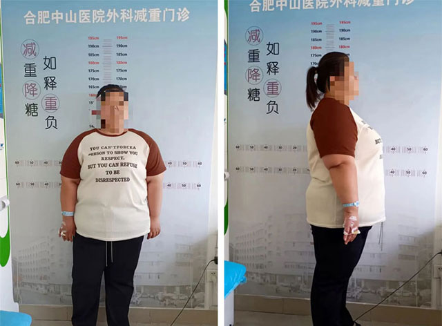 減肥不能“管住嘴”？不妨看看這個“管住胃”的方法