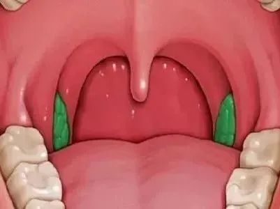 孩子扁桃體肥大，該不該切除？