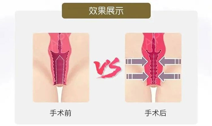 盆底肌修復究竟有多重要？