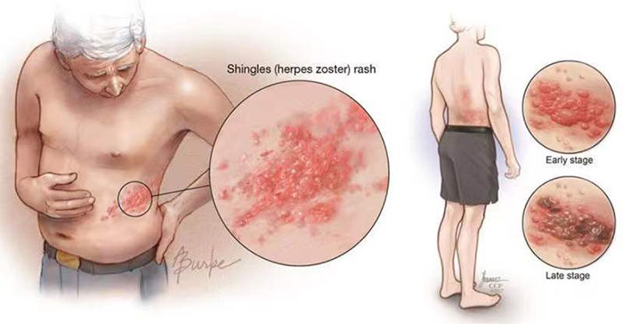 有一種劇痛叫“帶狀皰疹”，這些人群需警惕！