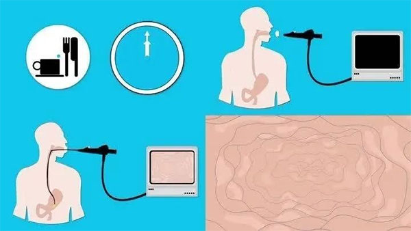 胃鏡檢查前后都要準(zhǔn)備和注意些啥？