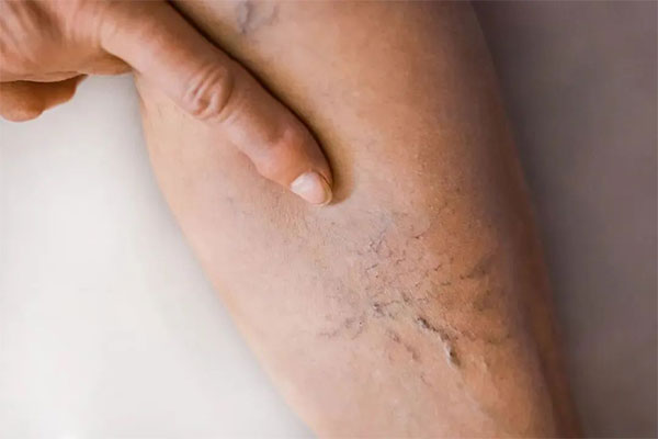 “蚯蚓腿”怎么辦？醫(yī)生：試試這幾種辦法