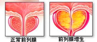 前列腺增生｜從癥狀到治療一文說清！