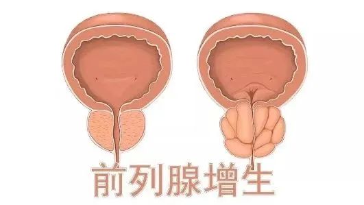 前列腺增生｜從癥狀到治療一文說清！