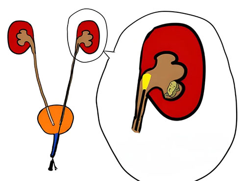 “夏日炎炎，痛不欲生”——夏季結(jié)石高發(fā)