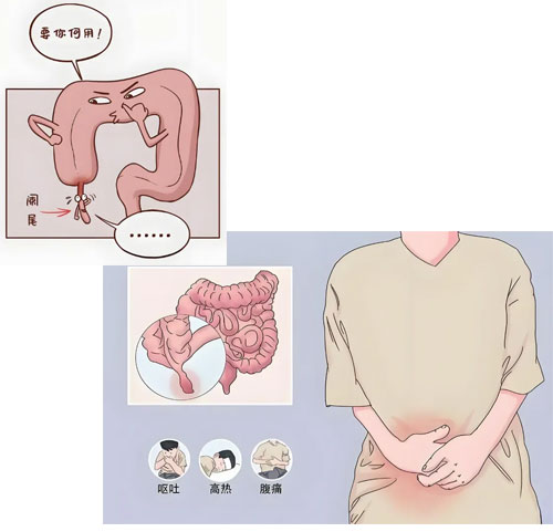 “小病”不可“小瞧”，急性化膿性闌尾炎