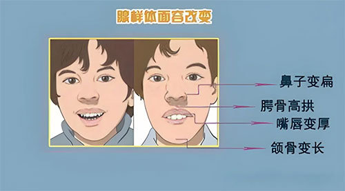 【惠民科普】急急急！小孩腺樣體肥大，究竟要不要切除？