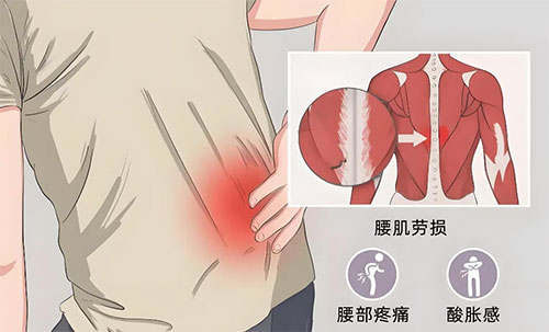 職業(yè)人遇上腰肌勞損——科學防治助你遠離疼痛困擾