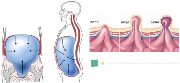 【惠民科普】健康守護，從“腹”開始——腹股溝疝