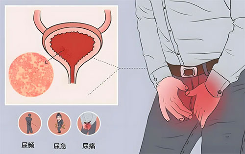 【惠民科普】揭秘‘男’言之隱：前列腺增生