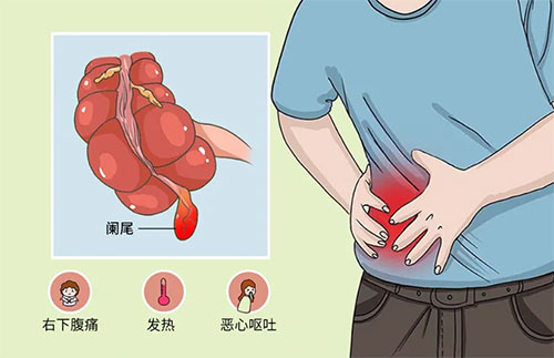 【惠民科普】腹痛、惡心、嘔吐......當(dāng)心急性闌尾炎找上門