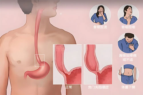 【惠民科普】73歲大爺吃啥吐啥，骨瘦如柴原因竟是食管賁門失弛緩癥??！